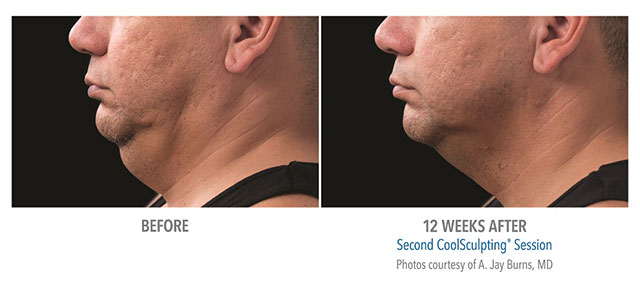Before and After Men's Coolsculpting