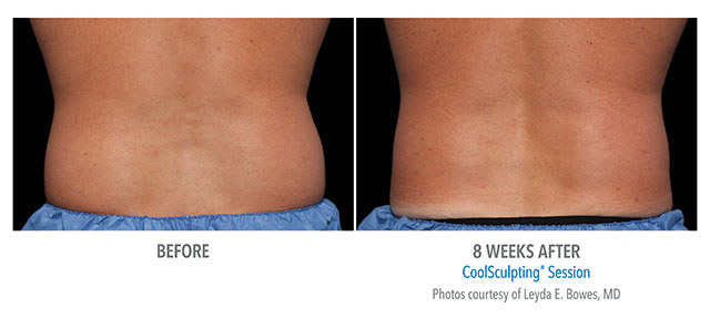 Before and After Men's Coolsculpting