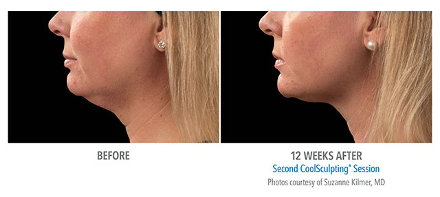 Before and After Coolsculpting